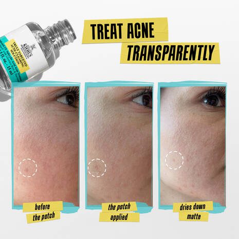 Immediate Mini Acne-Clearing Pimple Patch with Salicylic Acid - 4 ml